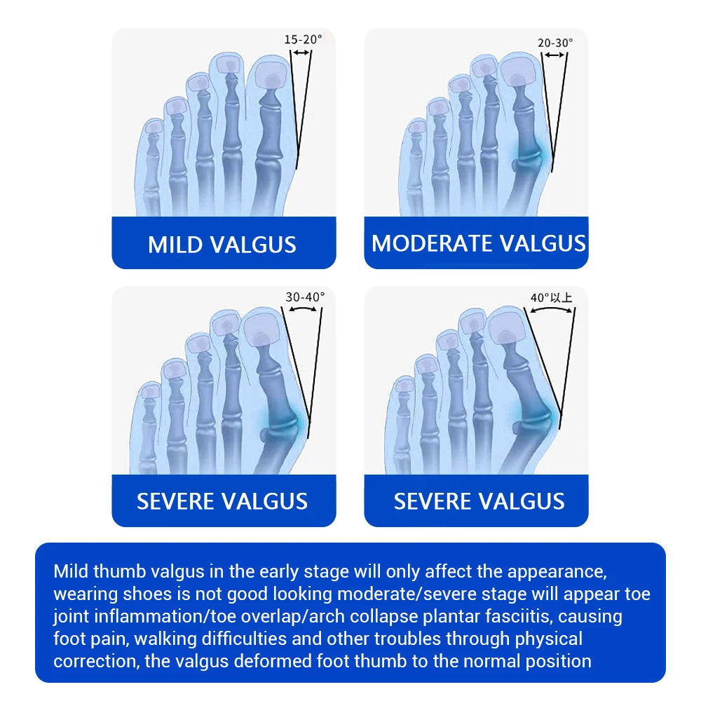 PastSky Bunion Corrector Toe Separator Orthotics For Realignment And Long Lasting Comfort
